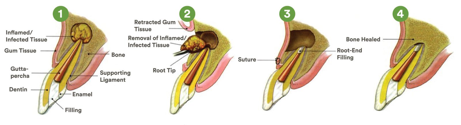 Apicoectomy