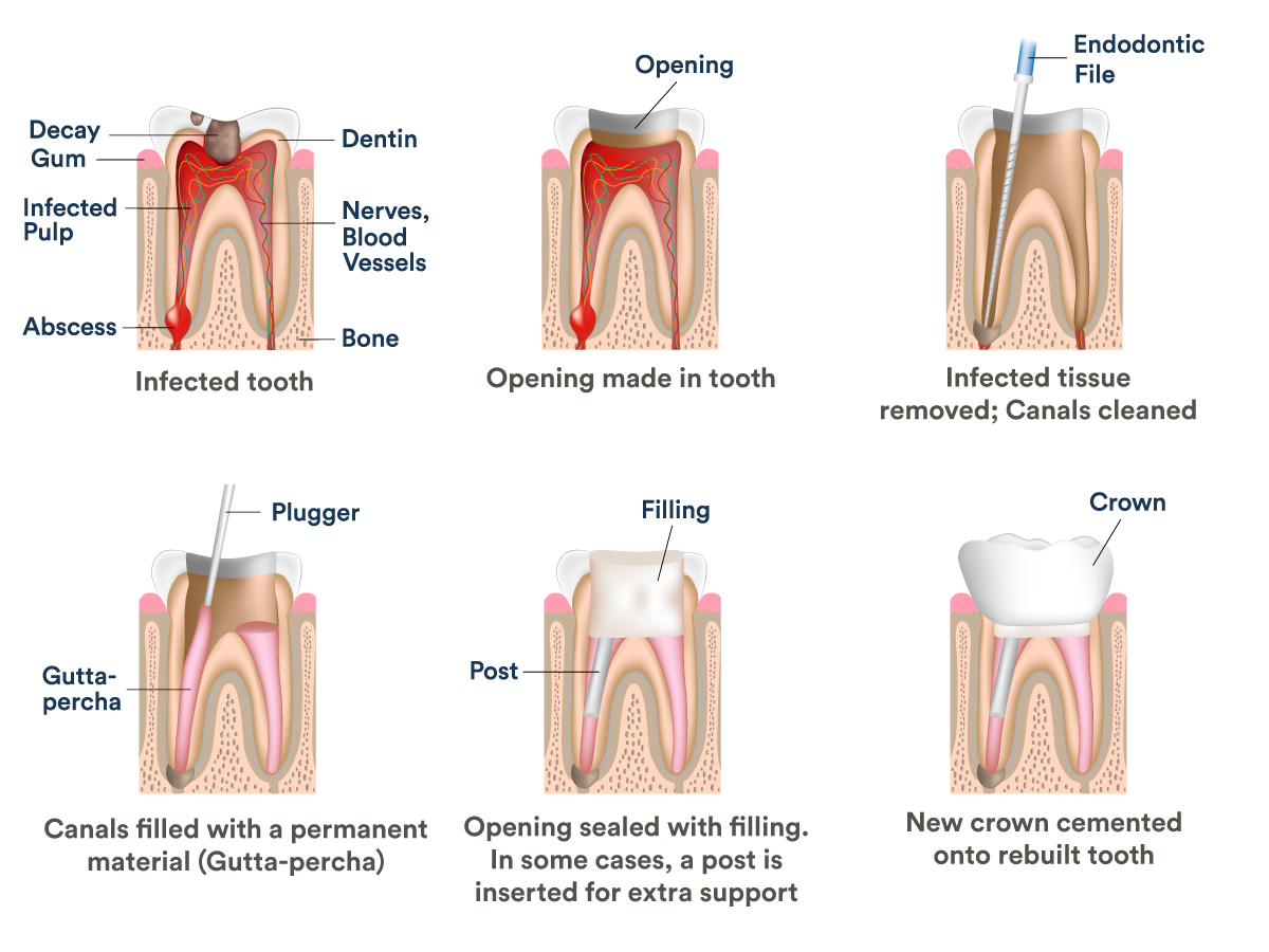 Root Canals